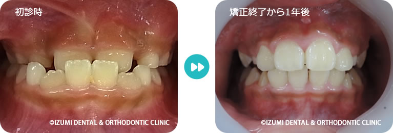 受け口1年6ヶ月後