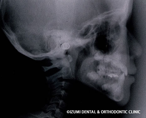 受け口の骨格治療終了