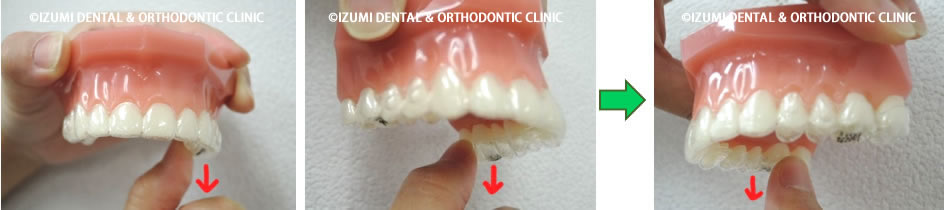 上のマウスピースの外し方