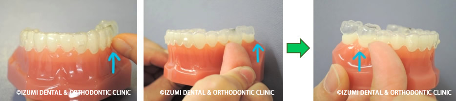 下のマウスピースの外し方
