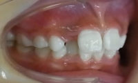 出っ歯（噛み合わせが低い）